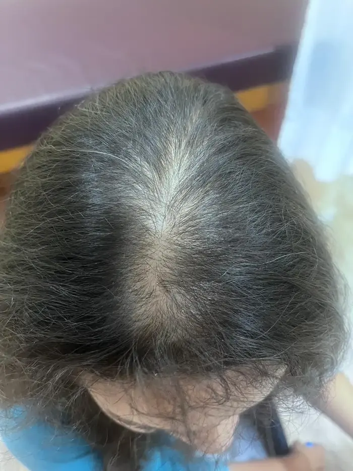 Female Pattern Baldness case 4 before treatment